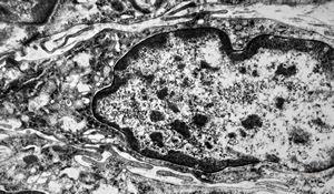 F,41y. | synovial metaplasia - capsule of implantate